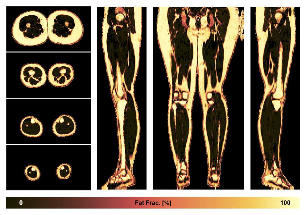 The fat fraction of the lower extremity obtained from the dixon reconstruction for muscle water fat quantification.